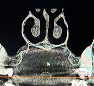 CT scan of the same nasal airway after two weeks of using HypoNasal.
