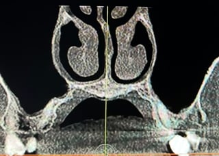 CT scan of the nasal airway before using HypoNasal.